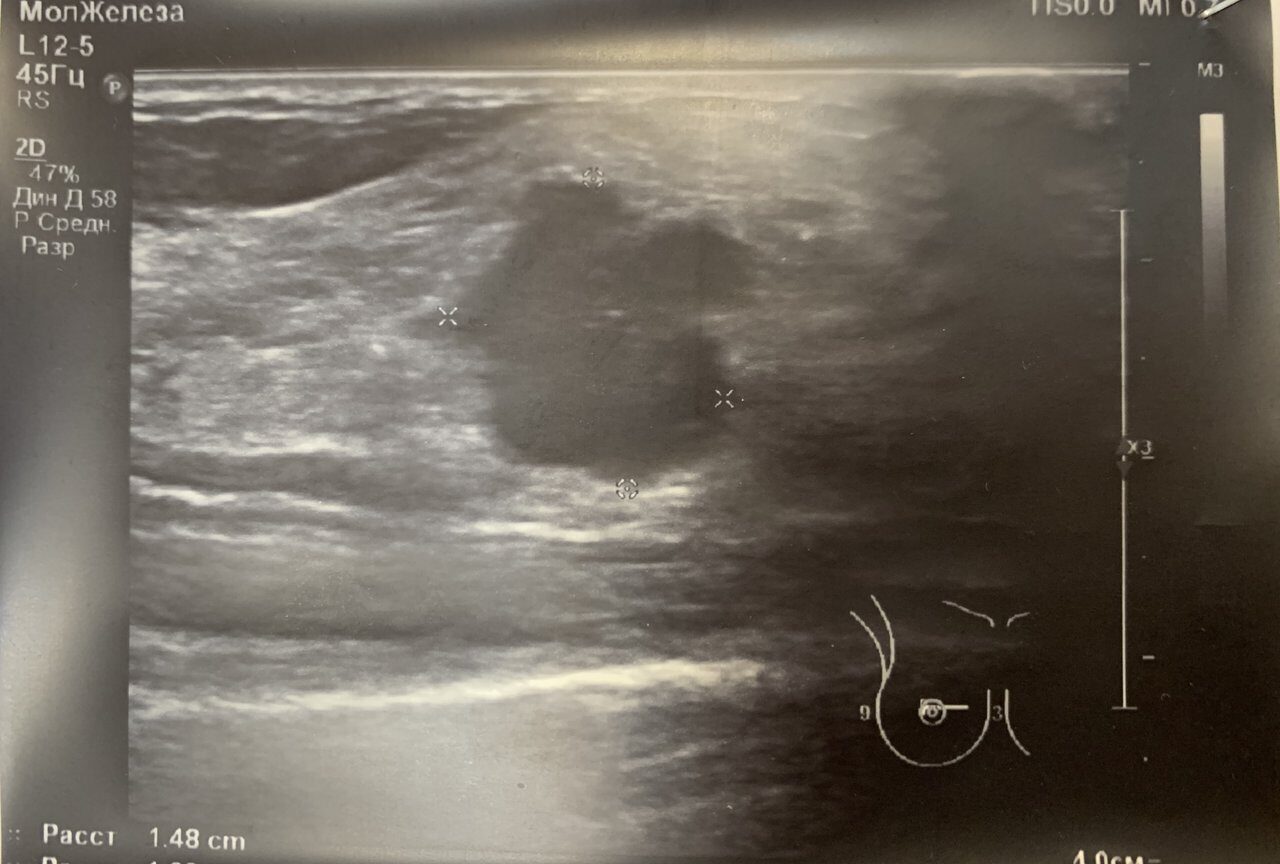 фиброаденома в груди при беременности фото 45
