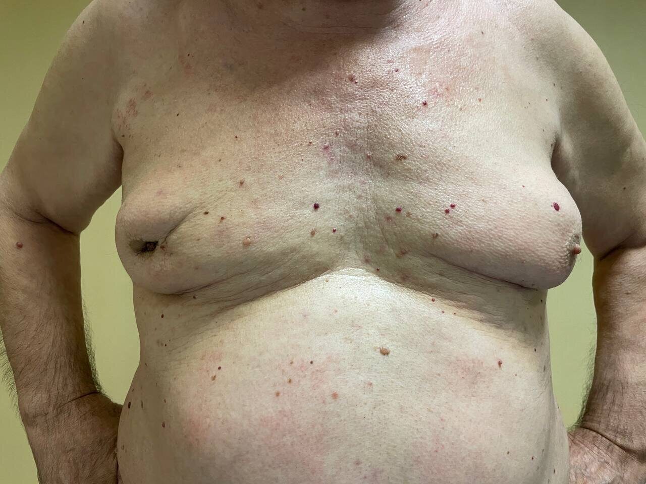 опухоль в районе груди у мужчин фото 7