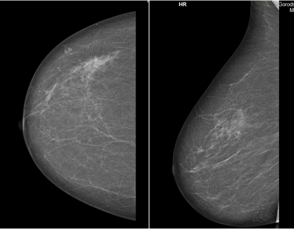 Маммография оренбург. Маммография молочных желез РМЖ. Мастопатия на маммографии. Атерома молочной железы маммография.