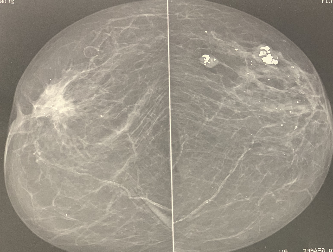 Маммография при раке молочной железы и для профилактики.